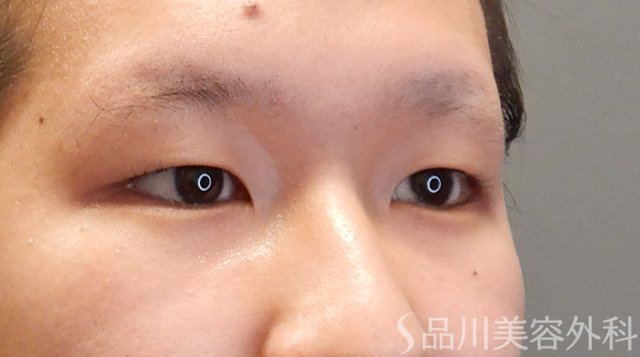 症例NO.75314のBEFORE写真