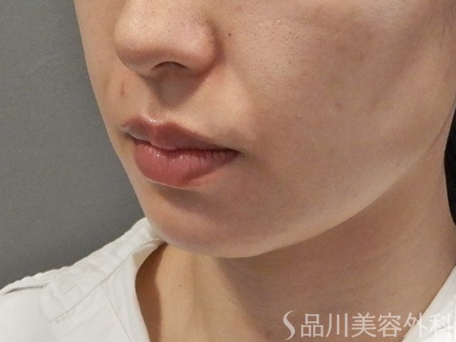 症例NO.74654のBEFORE写真