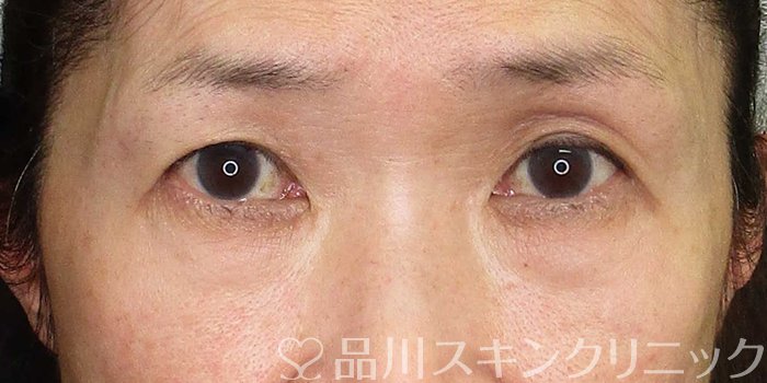 症例NO.70436のBEFORE写真