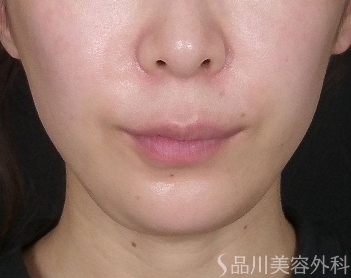 症例NO.69193のAFTER写真