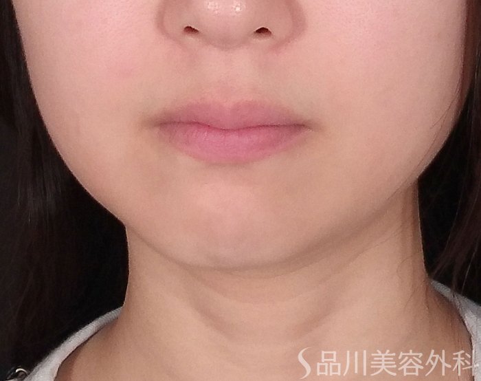 症例NO.74338のBEFORE写真