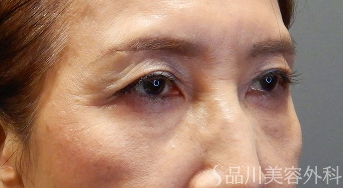 症例NO.71187のAFTER写真