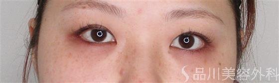 症例NO.55660のBEFORE写真
