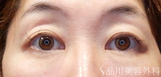 症例NO.67658のBEFORE写真
