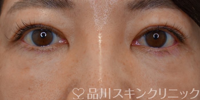 症例NO.72417のBEFORE写真