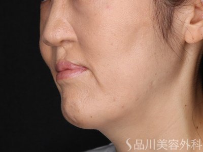 症例NO.72633のAFTER写真