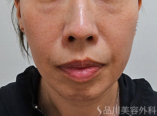 症例NO.75009のBEFORE写真