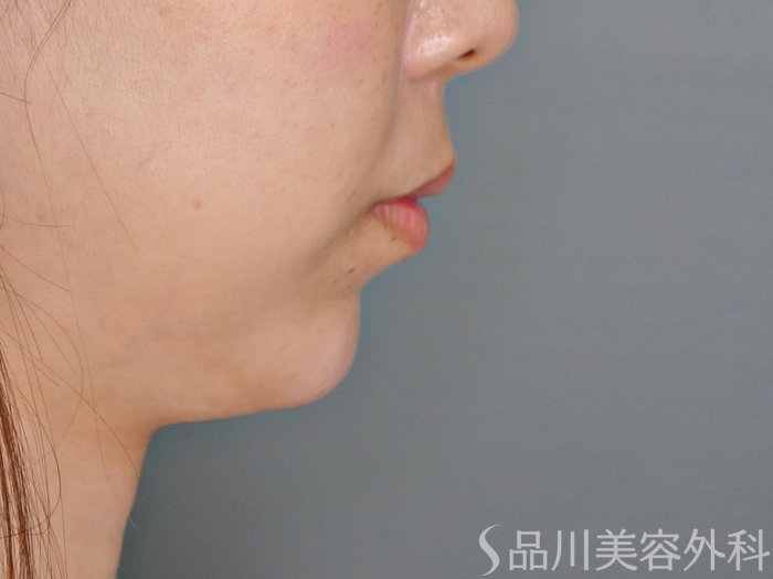 症例NO.70522のAFTER写真