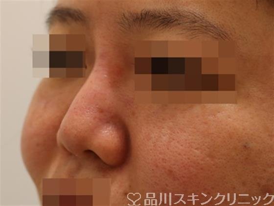 症例NO.39646のAFTER写真