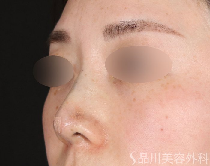 症例NO.72636のAFTER写真