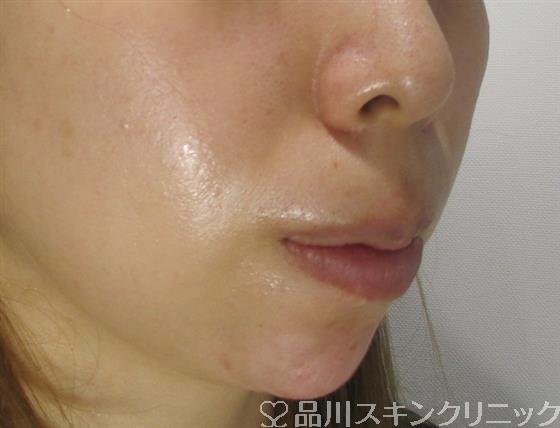 症例NO.35557のAFTER写真