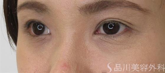 症例NO.48758のBEFORE写真