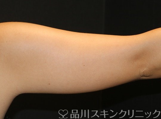 症例NO.71169のAFTER写真