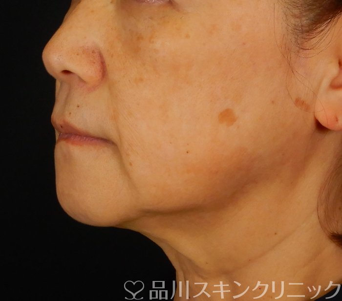 症例NO.65914のBEFORE写真