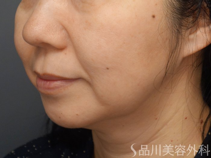 症例NO.69319のBEFORE写真
