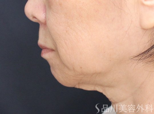 症例NO.71052のBEFORE写真