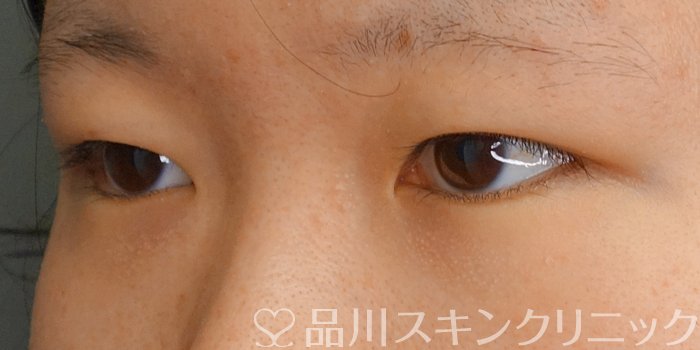 症例NO.71543のBEFORE写真