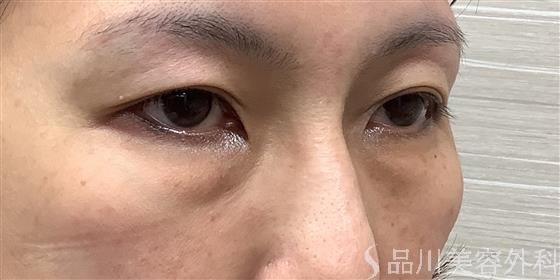 症例NO.55312のBEFORE写真