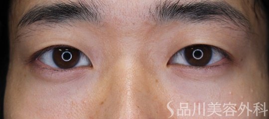 症例NO.63765のBEFORE写真