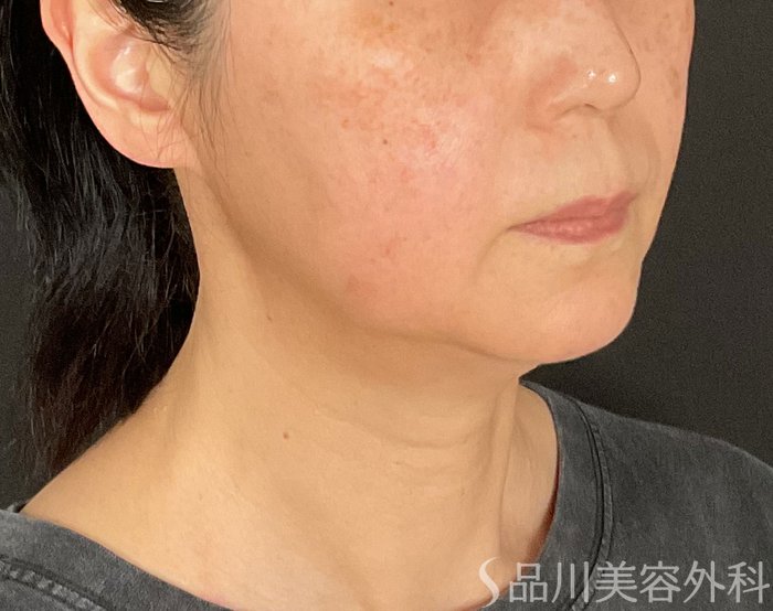 症例NO.74812のBEFORE写真