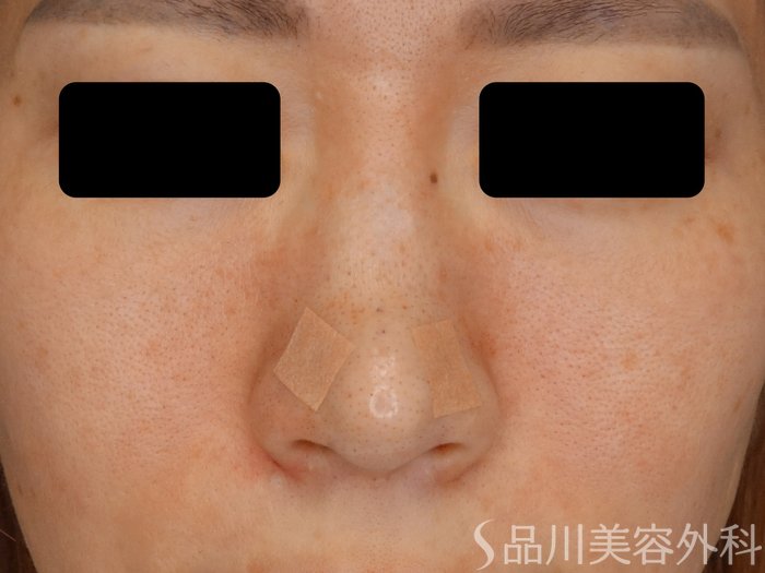 症例NO.72538のAFTER写真