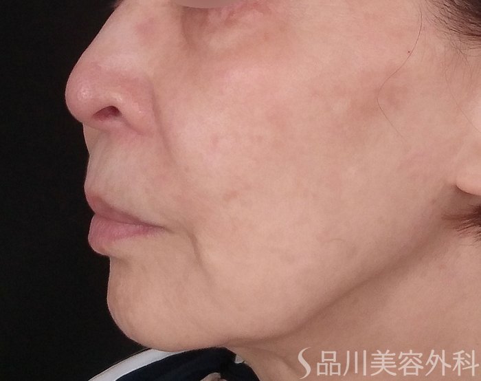 症例NO.70748のBEFORE写真