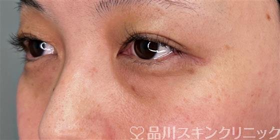 症例NO.56494のBEFORE写真
