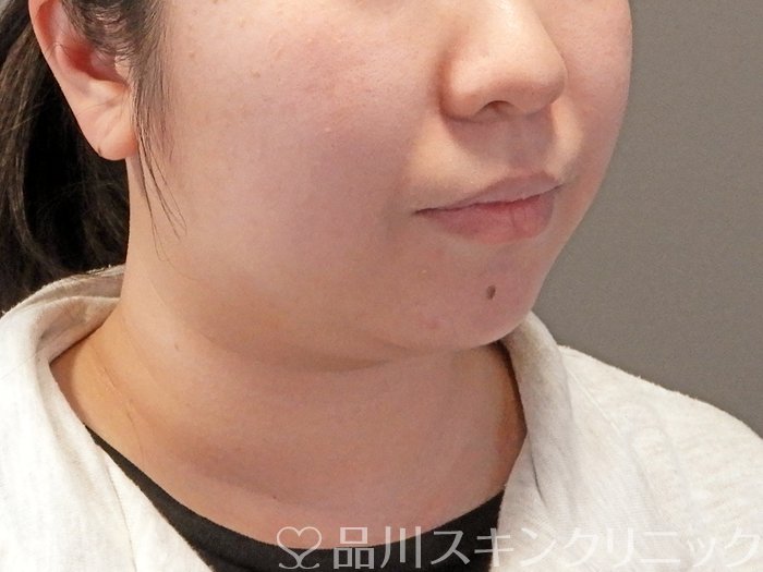 症例NO.64193のBEFORE写真