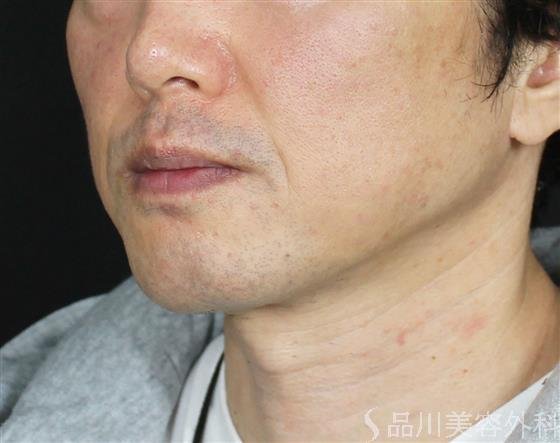 症例NO.59679のBEFORE写真