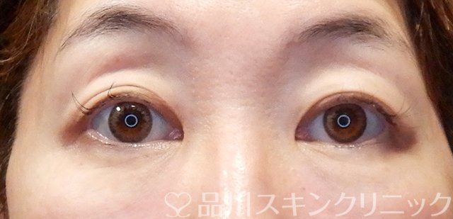 症例NO.67658のBEFORE写真