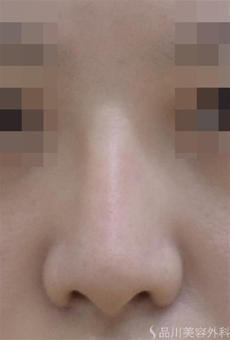 症例NO.46734のAFTER写真