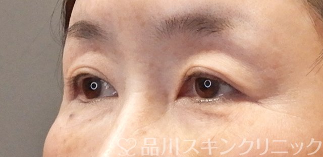 症例NO.67257のBEFORE写真
