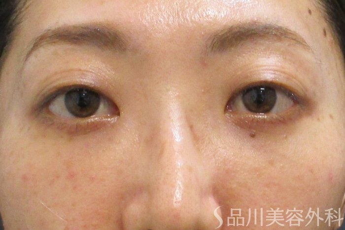 症例NO.69859のAFTER写真