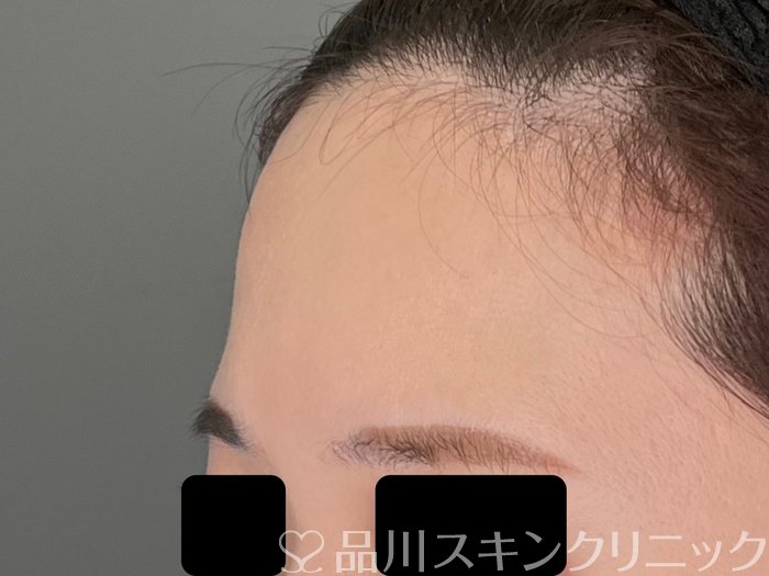 症例NO.69980のBEFORE写真