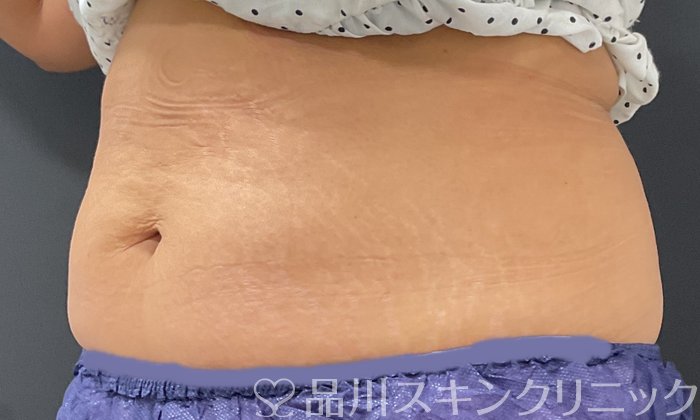 症例NO.74680のAFTER写真