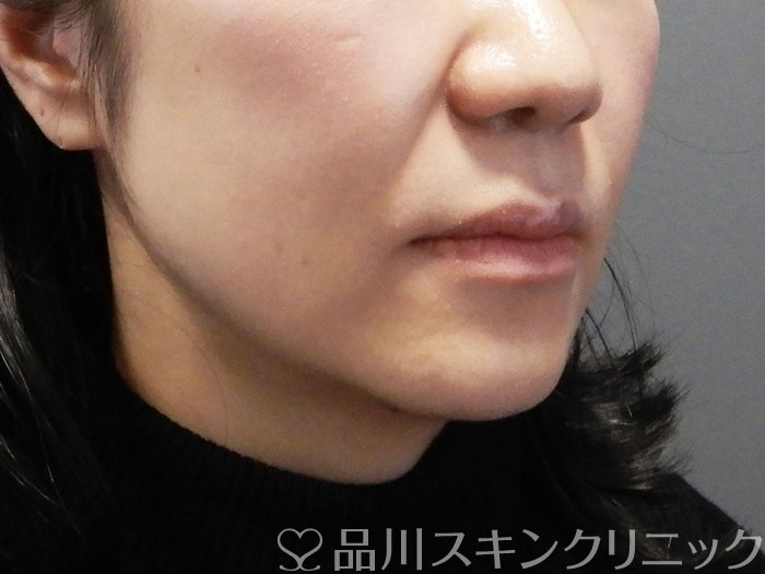 症例NO.73000のBEFORE写真