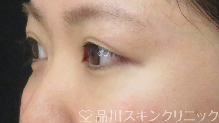 症例NO.71171のBEFORE写真