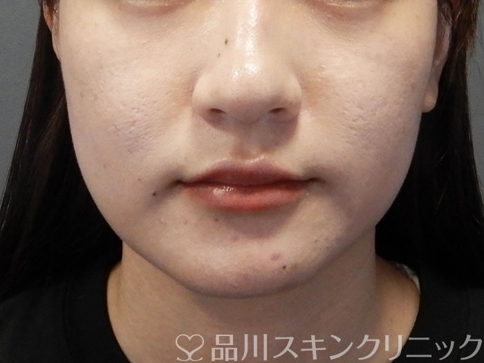 症例NO.73327のAFTER写真