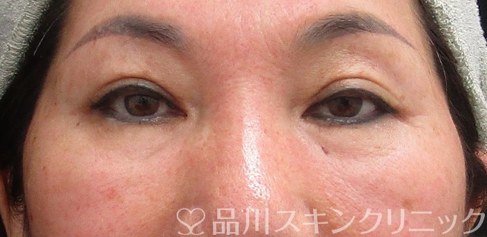 症例NO.69853のBEFORE写真