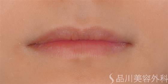 症例NO.55214のBEFORE写真