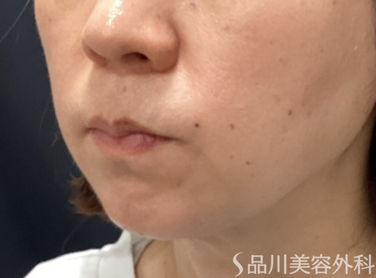 症例NO.74525のAFTER写真