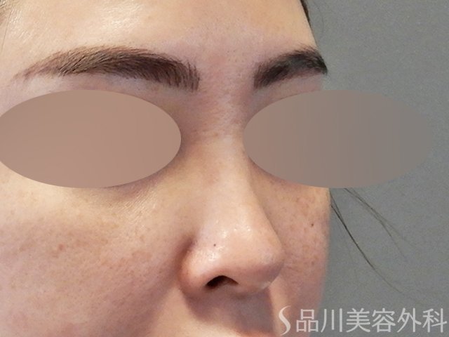 症例NO.67609のBEFORE写真