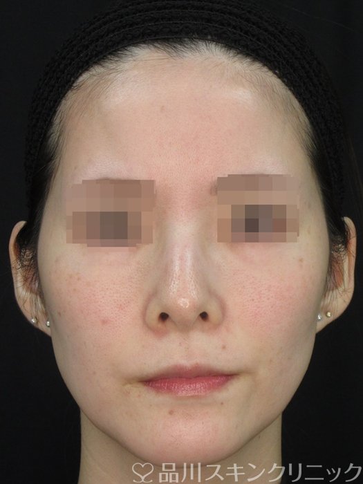 症例NO.72364のAFTER写真