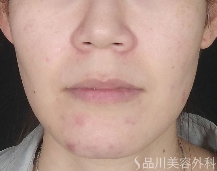 症例NO.65124のBEFORE写真