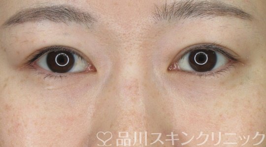 症例NO.70216のAFTER写真