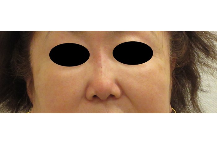 症例NO.75096のAFTER写真