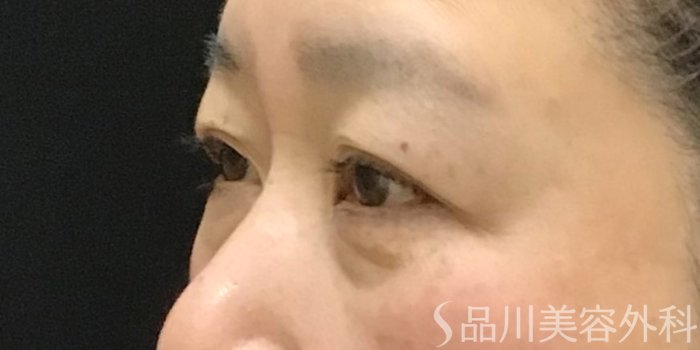 症例NO.70157のBEFORE写真