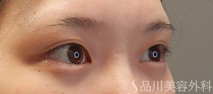 症例NO.71668のBEFORE写真
