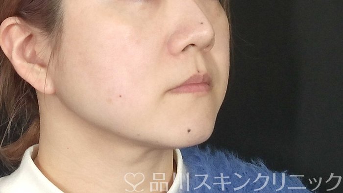 症例NO.72998のBEFORE写真