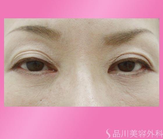 症例NO.820のAFTER写真